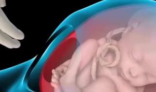 胎儿脐带绕颈怎么办 胎儿脐带绕颈怎么办